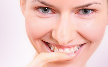 Feste Zahnspange für gerade Zähne